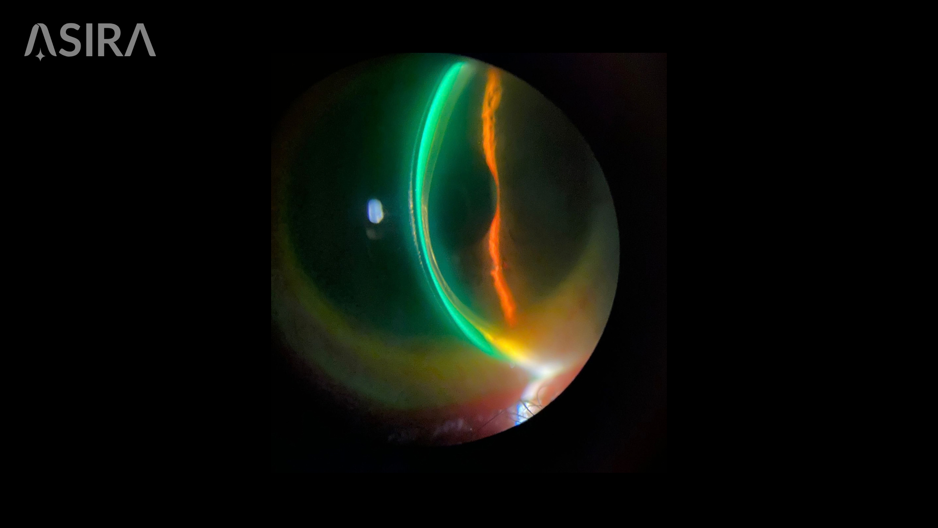 Why Specialty Contact Lens Fitting Requires a Different Kind of Optometrist