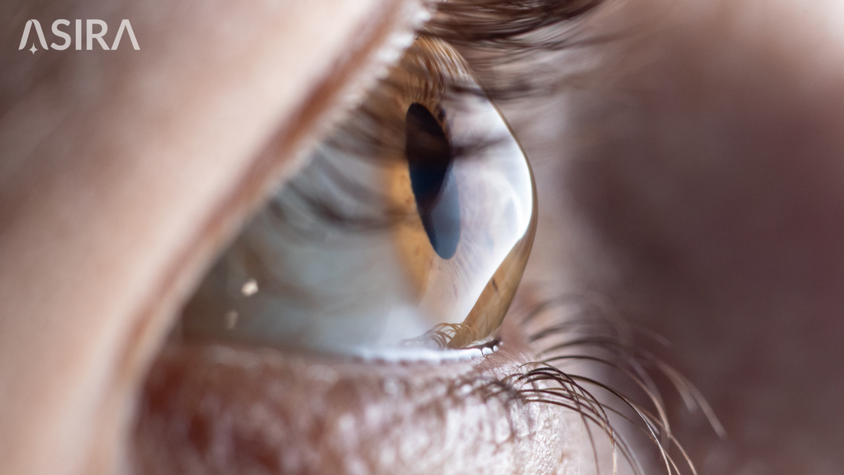 Artificial Intelligence for Detecting Keratoconus: What the Latest Evidence Says and Why It Matters for India