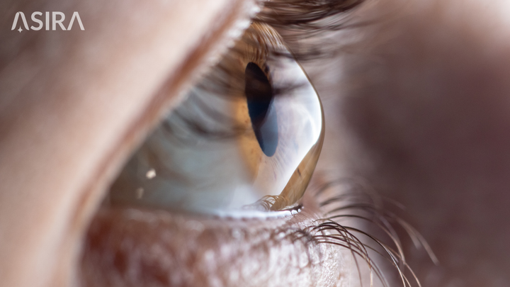 Artificial Intelligence for Detecting Keratoconus: What the Latest Evidence Says and Why It Matters for India